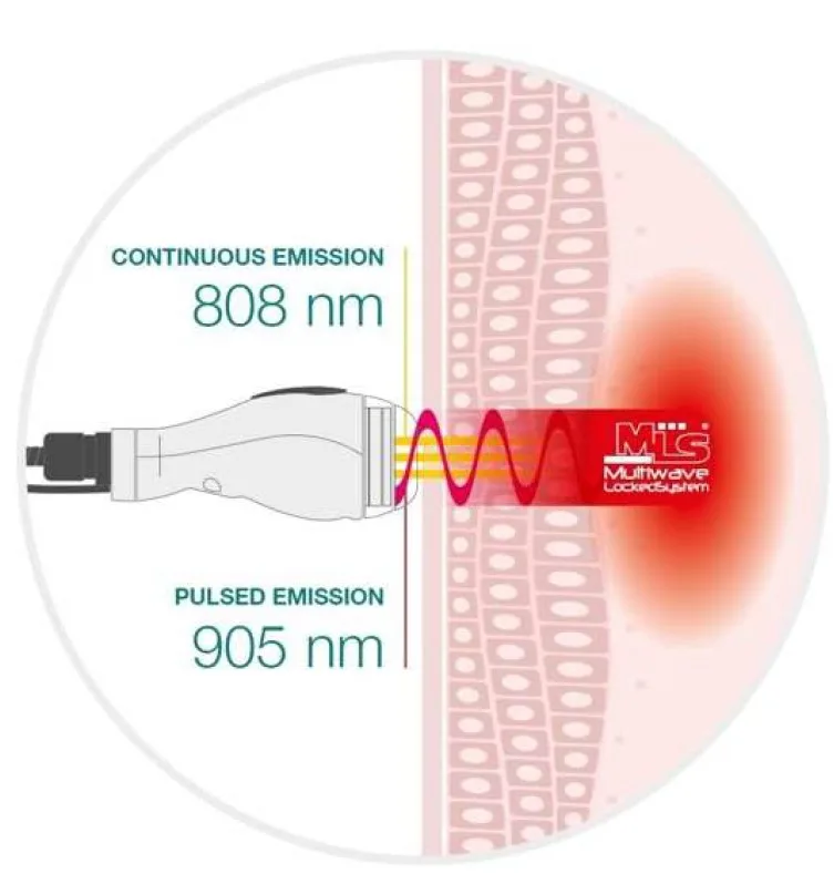 MLS dual-wavelength diagram: 808nm continuous and 905nm pulsed emission